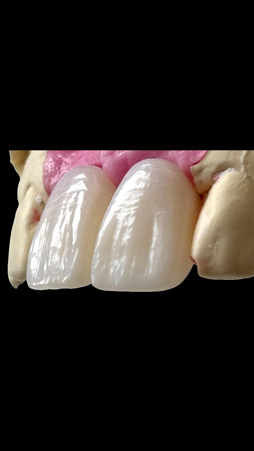 odontonight carga ceramica 2